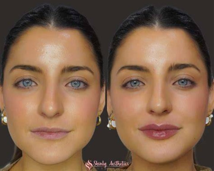Can Lip Injections Make Your Lips Dry as a Side Effect? Allure