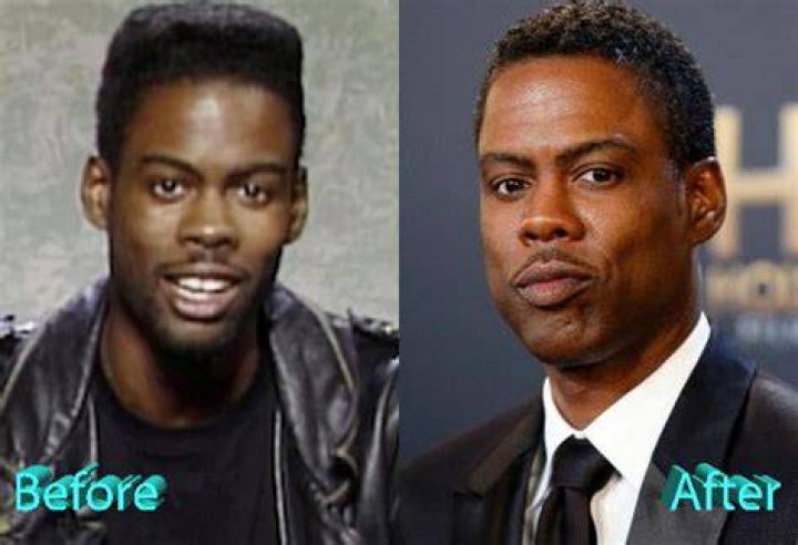 Chris Rock Plastic Surgery A Real Improvement For Chris