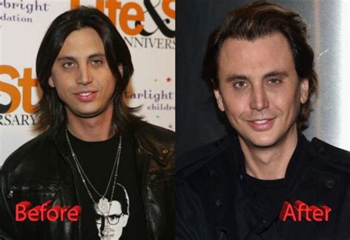 Jonathan Cheban plastic surgery 01 Celebrity plastic surgery online