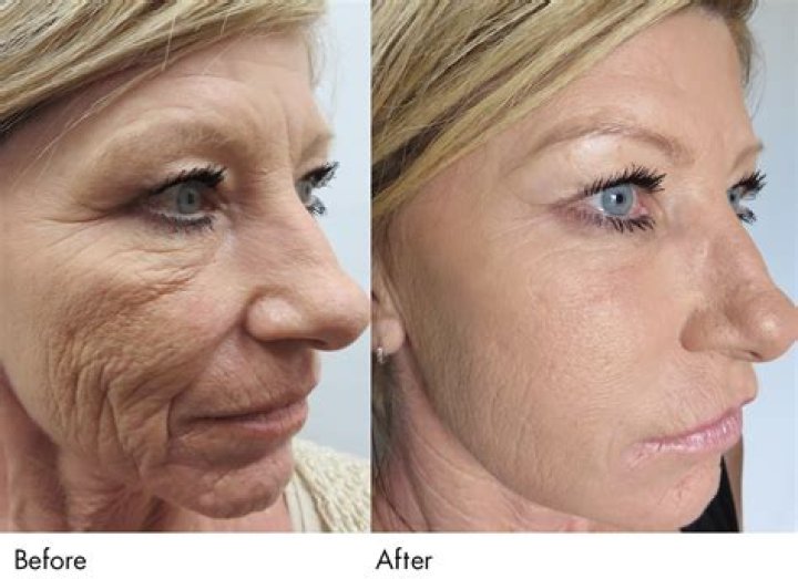 Microneedling Treatment Eclat SPA