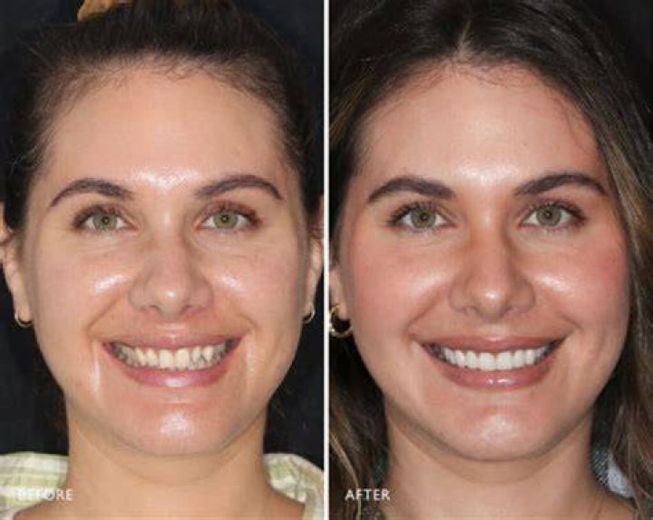 Nany Gonzalez Before And After Veneers Transformation
