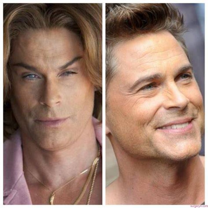 Rob Lowe Plastic Surgery Facelift, Botox, Chin Implant