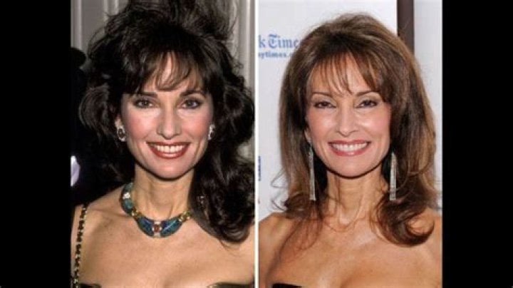 Susan Page Plastic Surgery The Truth About Her Transformation! Lee Daily